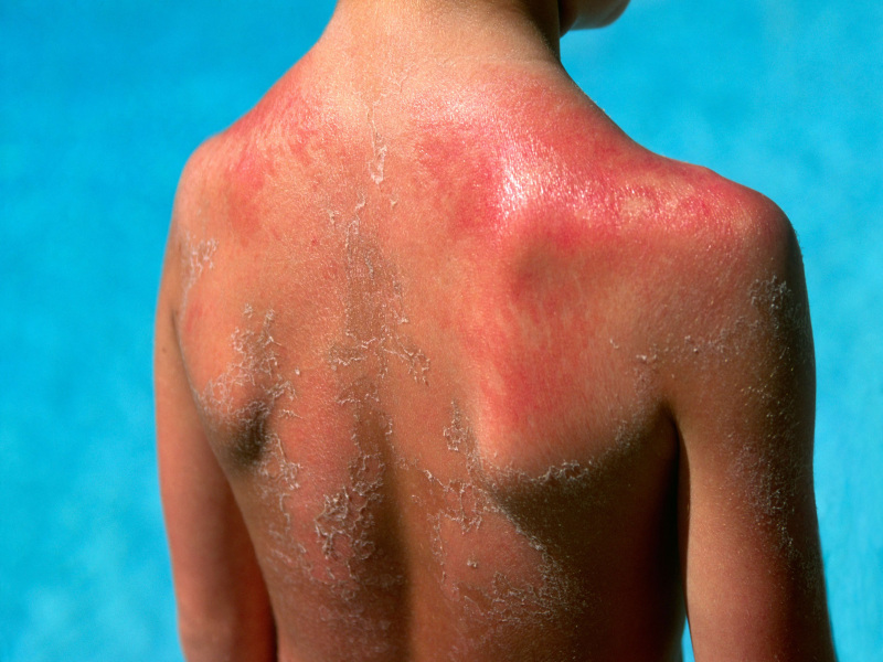 درمان آفتاب سوختگی کودکان در خانه با 6 روش آسان